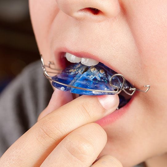 dentist in Westminster palatal expander