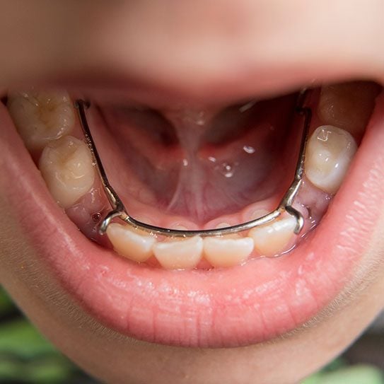 pediatric dentist in Westminster space maintainers